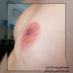 طراحی سینه با تتو پزشکی
