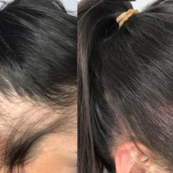 scalp-micro-pigmentation-1