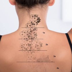 tattoo-removal-healing1FILEminimizer